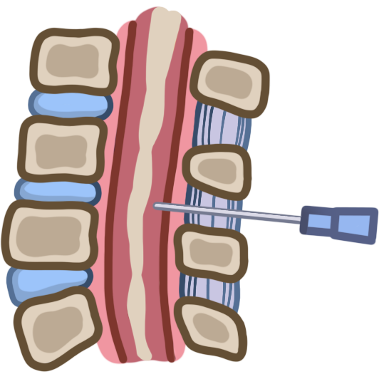 A cross section of a spine with a syringe in one side of it.